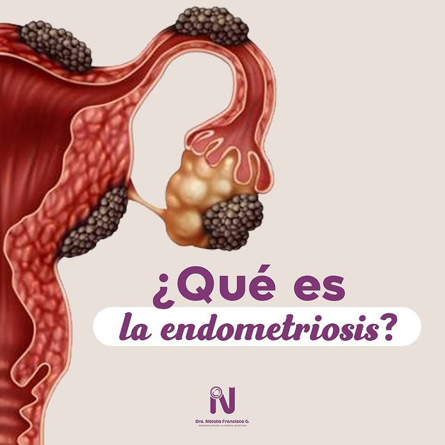 endometriosis