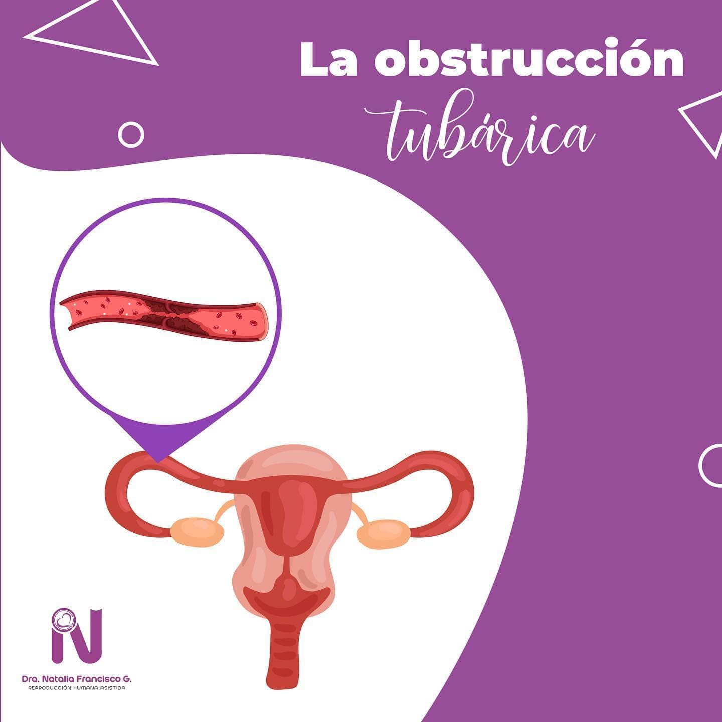 obstruccion-tubarica