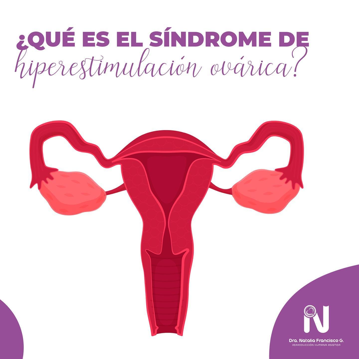 sindrome-hiperestimulacion